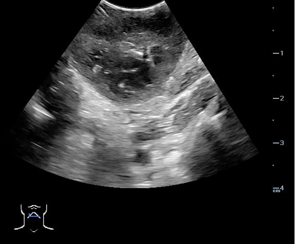 -Figure 45 - PTA Aspiration.jpg