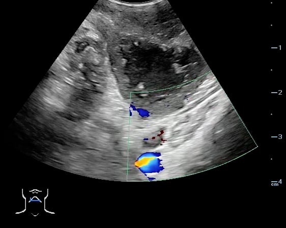-Figure 47 - PTA with color doppler of carotid artery.jpg