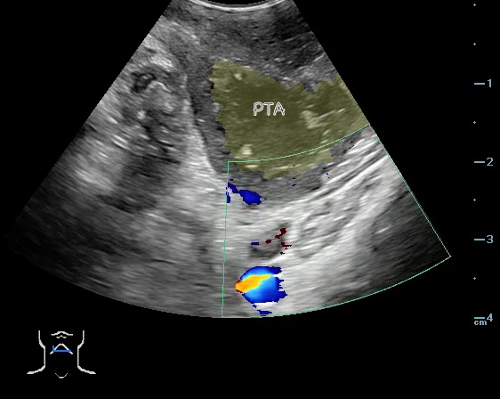 -Figure 48 - PTA with color.png