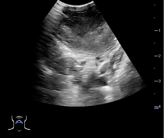 -Figure 49 - PTA Aspiration Resolution.jpg