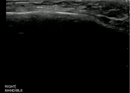 -Figure 5 - Normal Mandible.jpg
