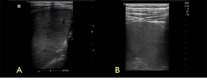 Figure 10. Spleen with high frequency linear transducer.jpg