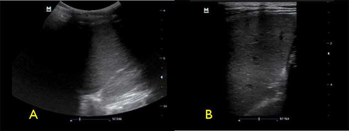 Figure 4 Spleen with low frequsncy (A) vs high frequency (B) transducers.jpg