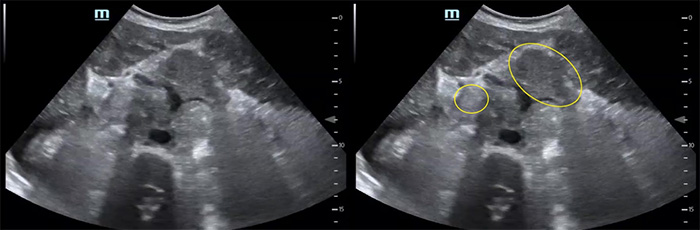 Figure 6 Numerous periaortic lymph nodes.jpg
