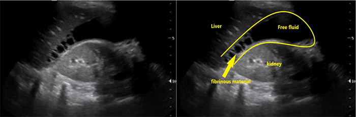 Figure 8. RUQ free fluid with fibrinous stranding and hyperechoic liver lesions.jpg