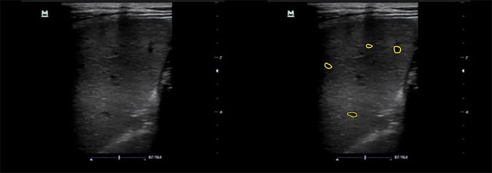 Figure 9 Spleen with microabscesses using linear transducer.jpg