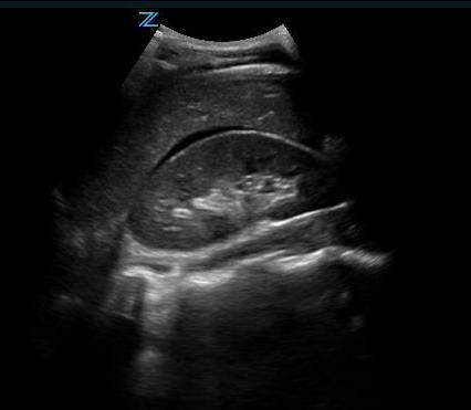 Figure 5 - Small amount of free fluid Morison’s pouch view.jpg