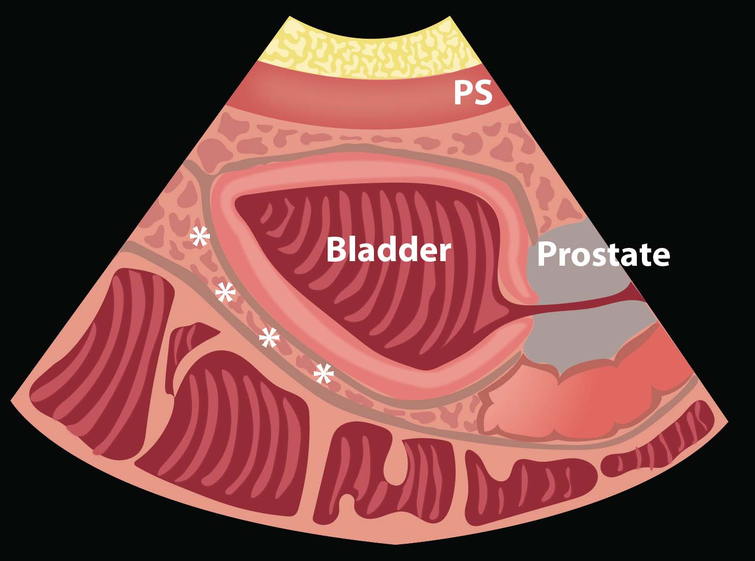 Ill 7_Potential spaces where free fluid collects.jpg