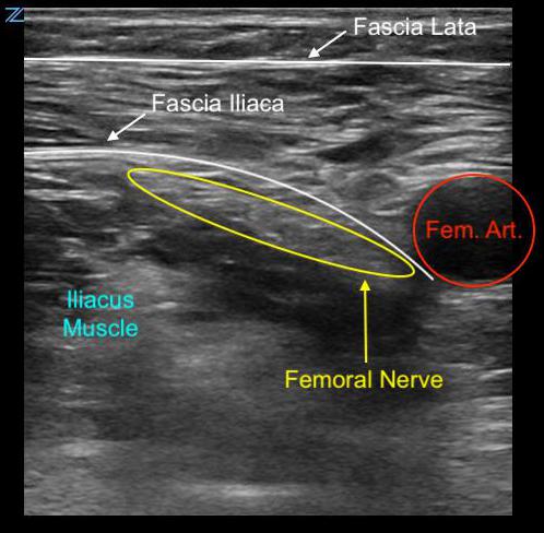 Figure 1. Transverse Anatomy of the Femoral Triangle .jpg