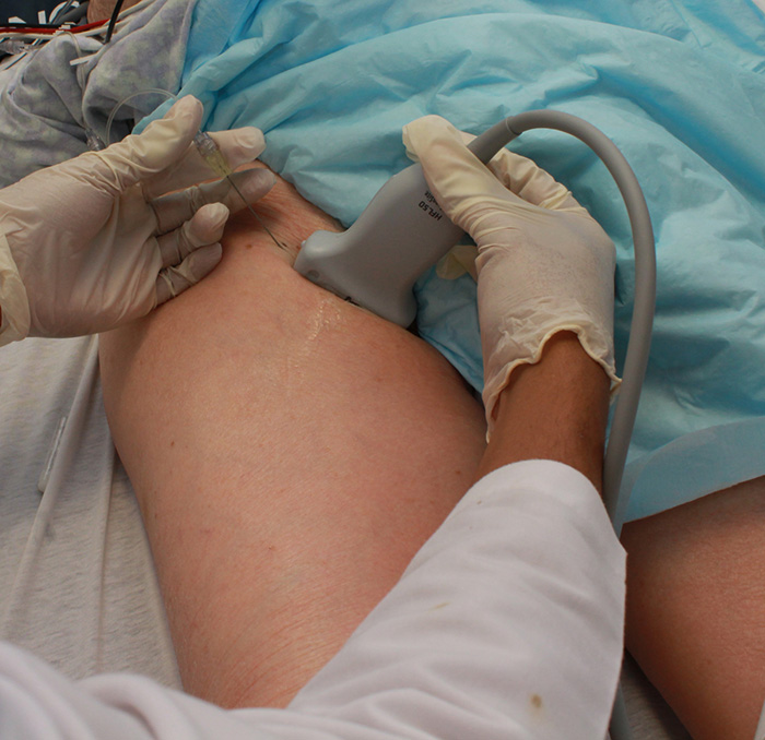 Figure 2. Hand Positioning for the Femoral Block.jpg