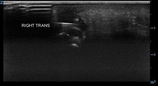 Figure 3. Reverberation from metal foreign body.jpg