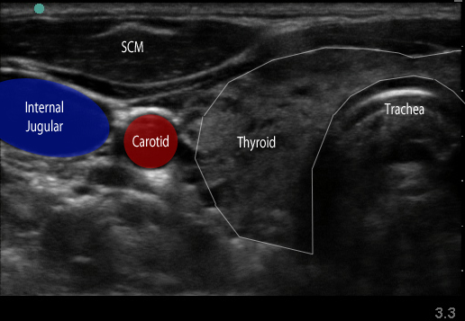 Figure 1. Transverse view over the sternocleidomastoid.jpg