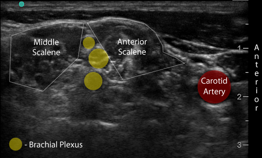 Figure 2b. Transverse view through the interscalene space with labels.jpg