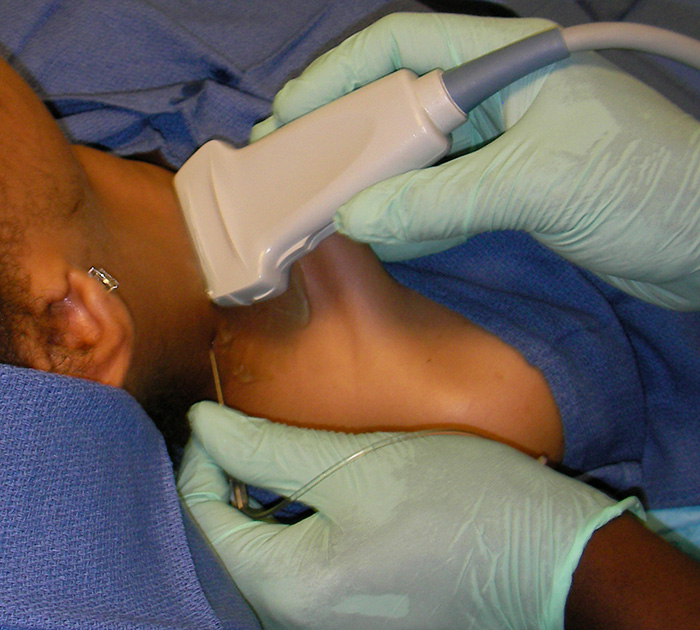 Figure 3. Needle placement for the interscalene block.jpg