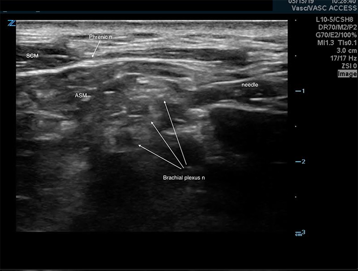 Figure 4. Phrenic nerve.jpg