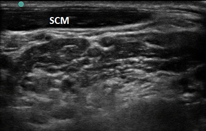 Figure 5.  SCM with improper head turn.jpg