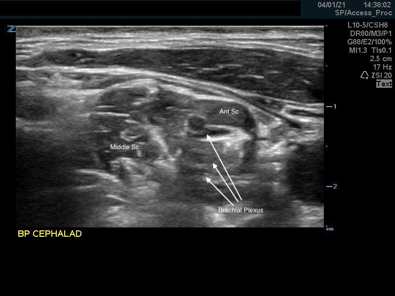 Figure 7. Anterior scalene muscle cephalad.jpg