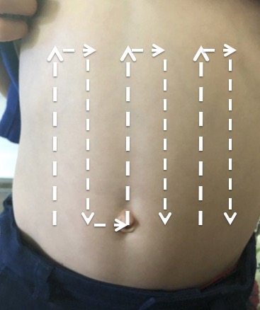 Figure 2- Surface anatomy image describing the lawn mower technique to evaluate for intussu_mEil.jpg