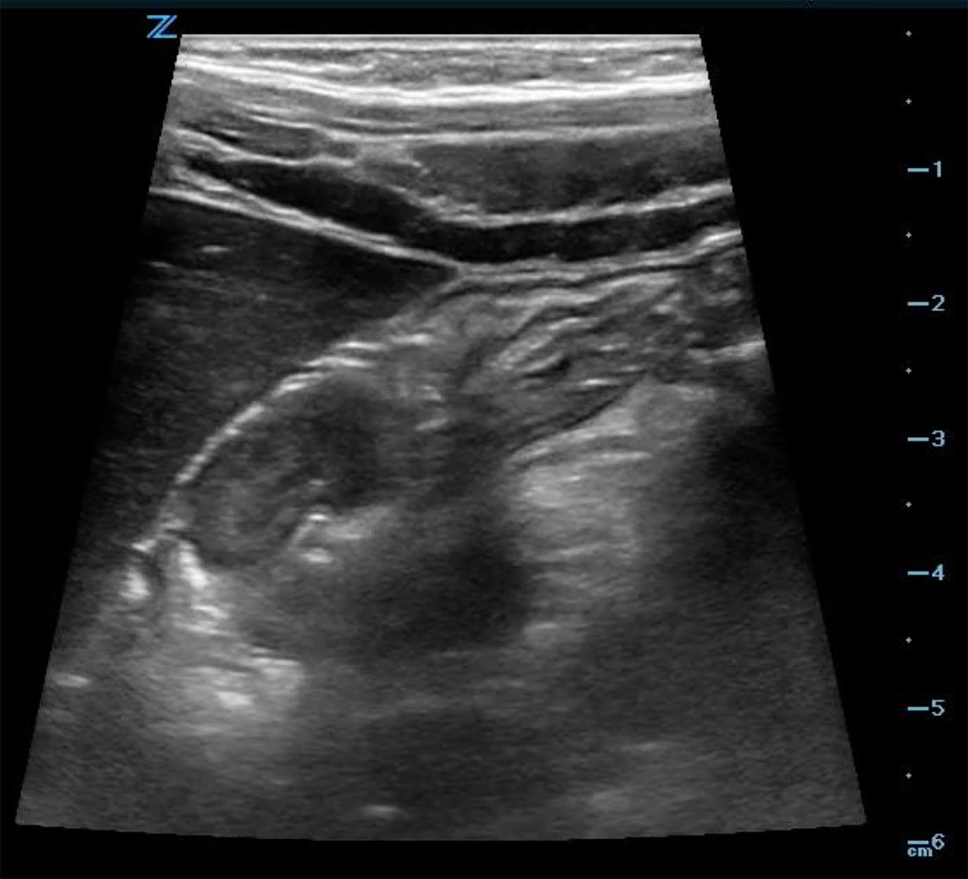 Figure 6a - Ileocolic intuss long axis.jpg
