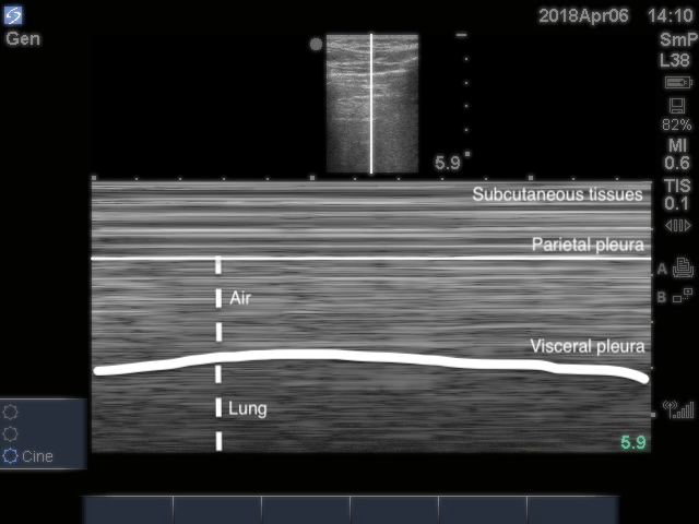 Image 16 - Stratosphere sign in M-mode.jpg