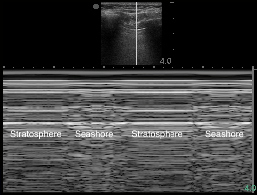 Image 17 - Lung point in M-mode.png
