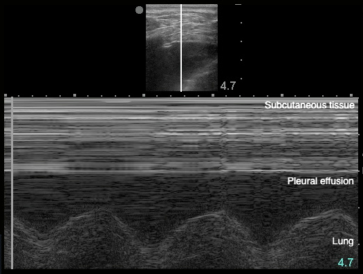 Image 20 - Sinusoid sign.png