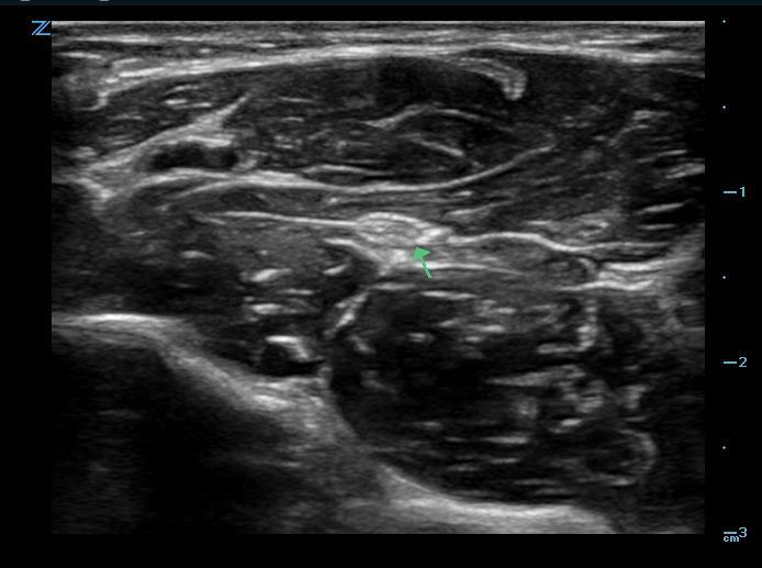 Figure 1 - Median nerve in forearm.png