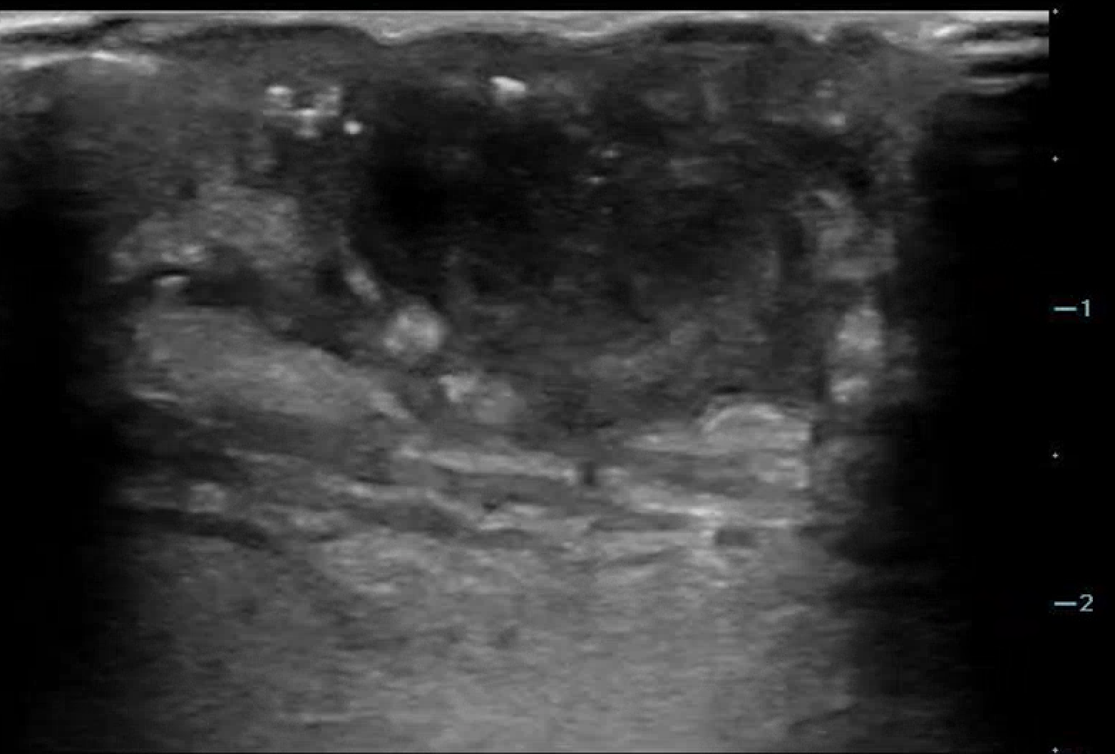 MSK-Figure 10 - Abscess.png