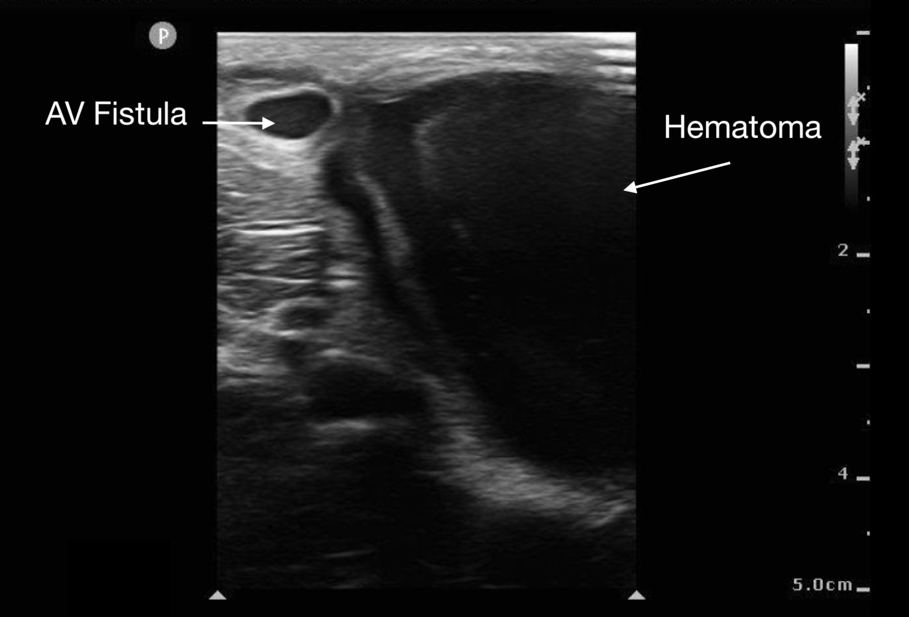 MSK-Figure 11 - Hematoma by fistula.png