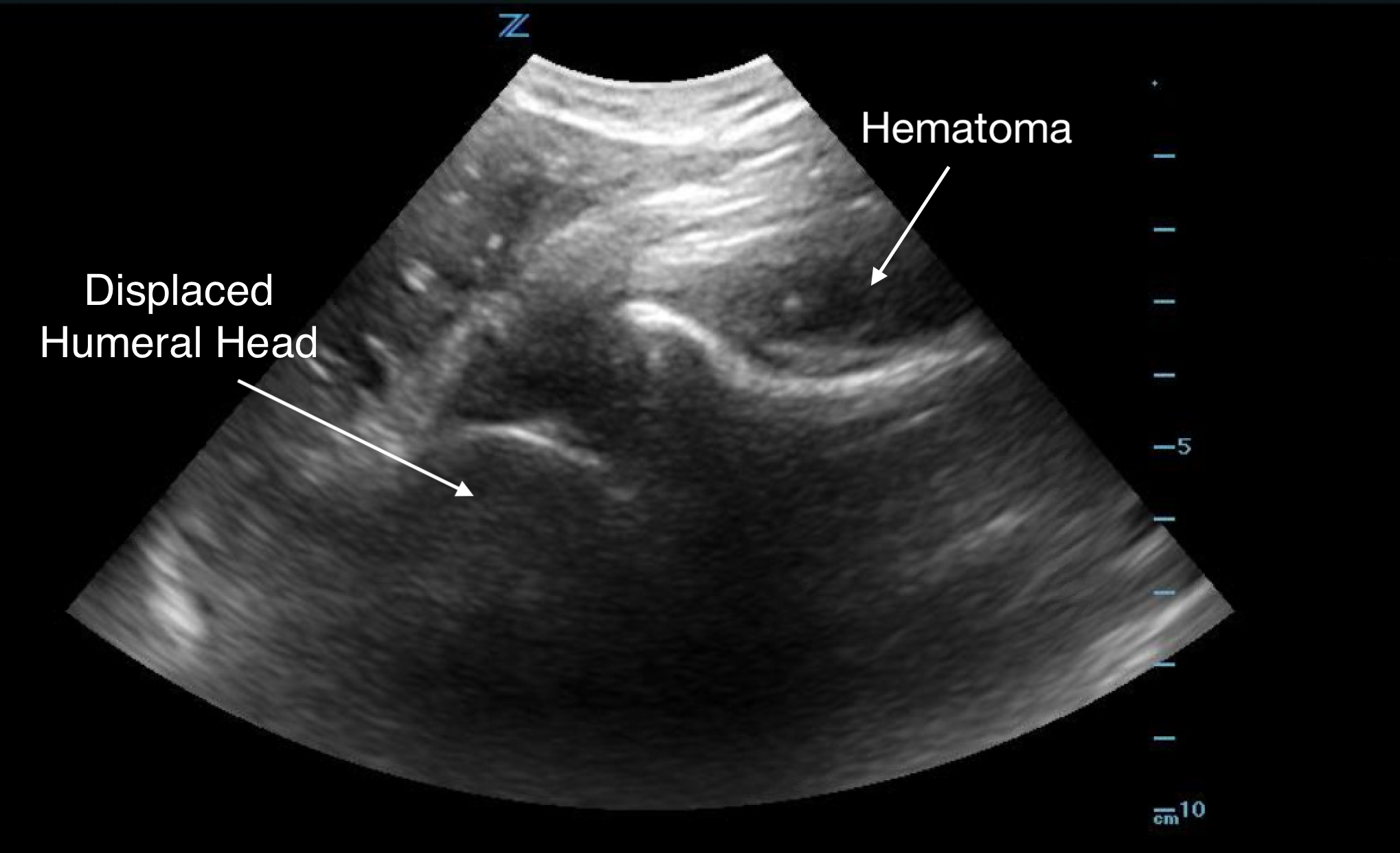 MSK-Figure 9 - Ant Shoulder dislocation.png
