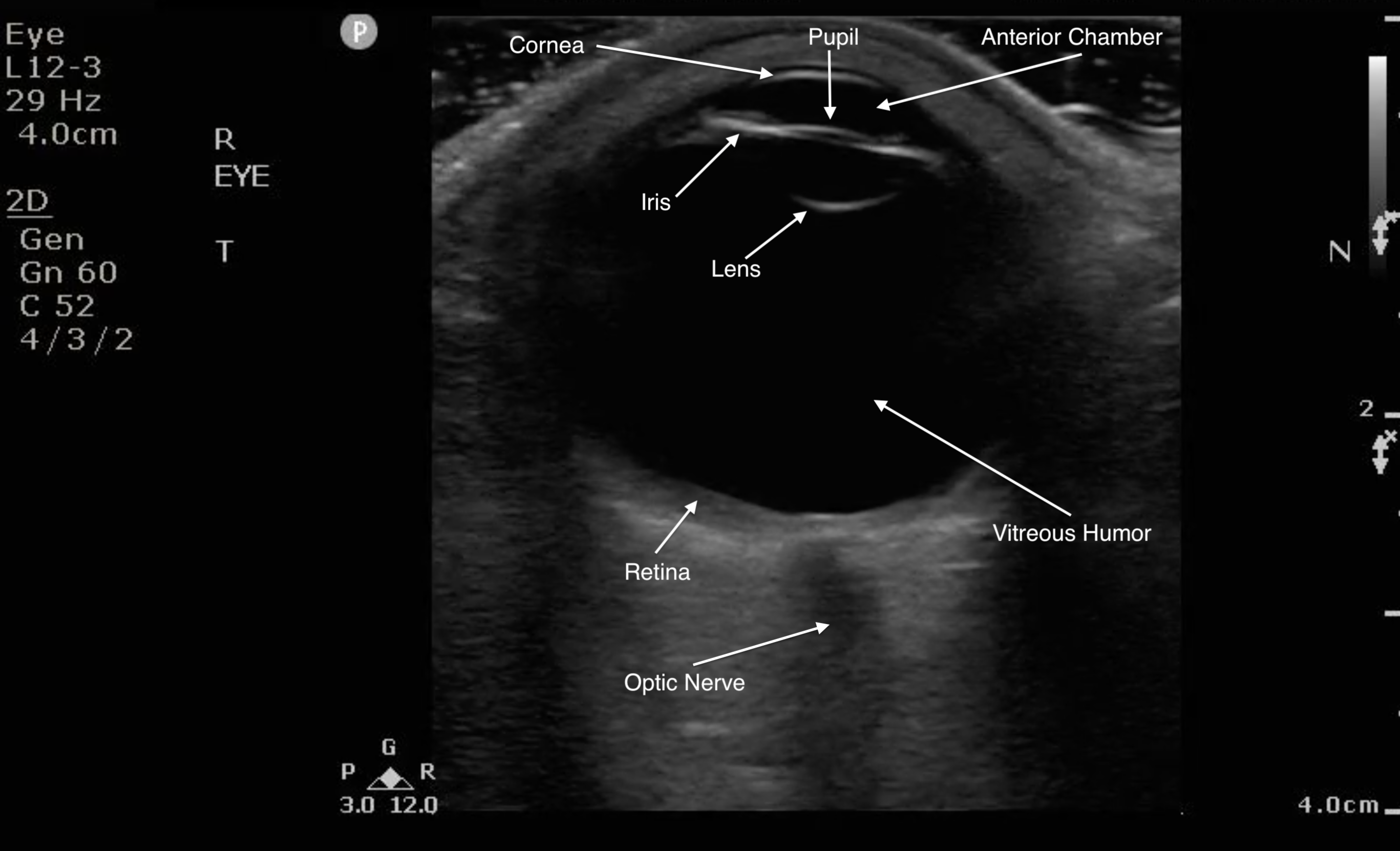 FIG 1- Normal Eye Anatomy.png
