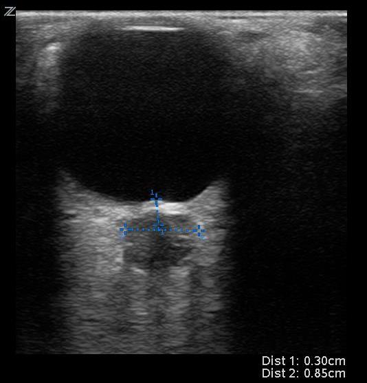 FIG 11 Increased ONSD.jpg