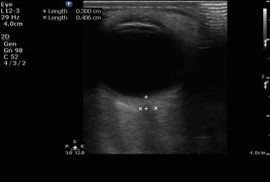 FIG 4- Normal optic nerve sheath diameter.jpg