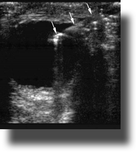 FIG 6- IO foreign body Matthew Lyon MD.png