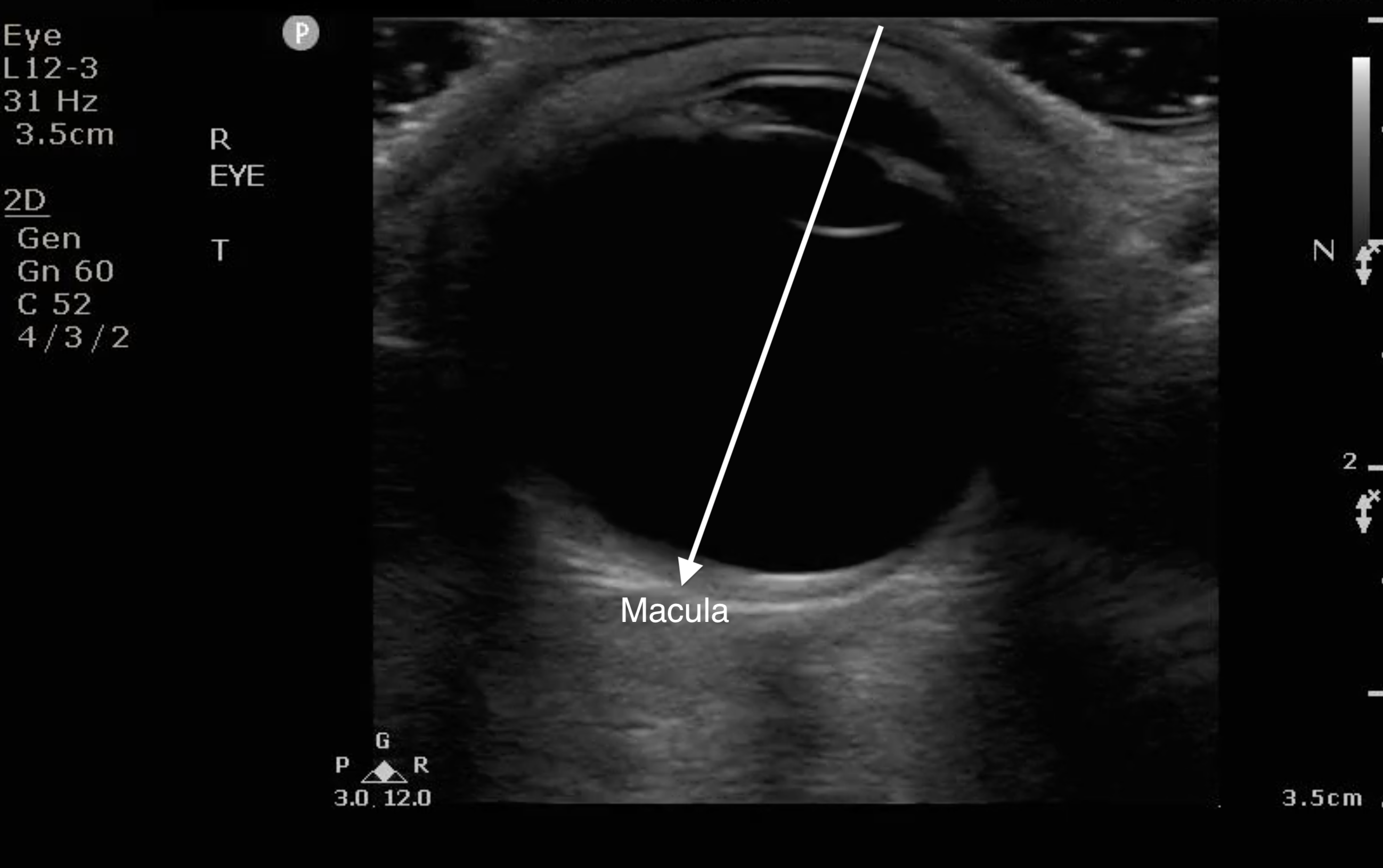 FIG 8 Macula Image.png
