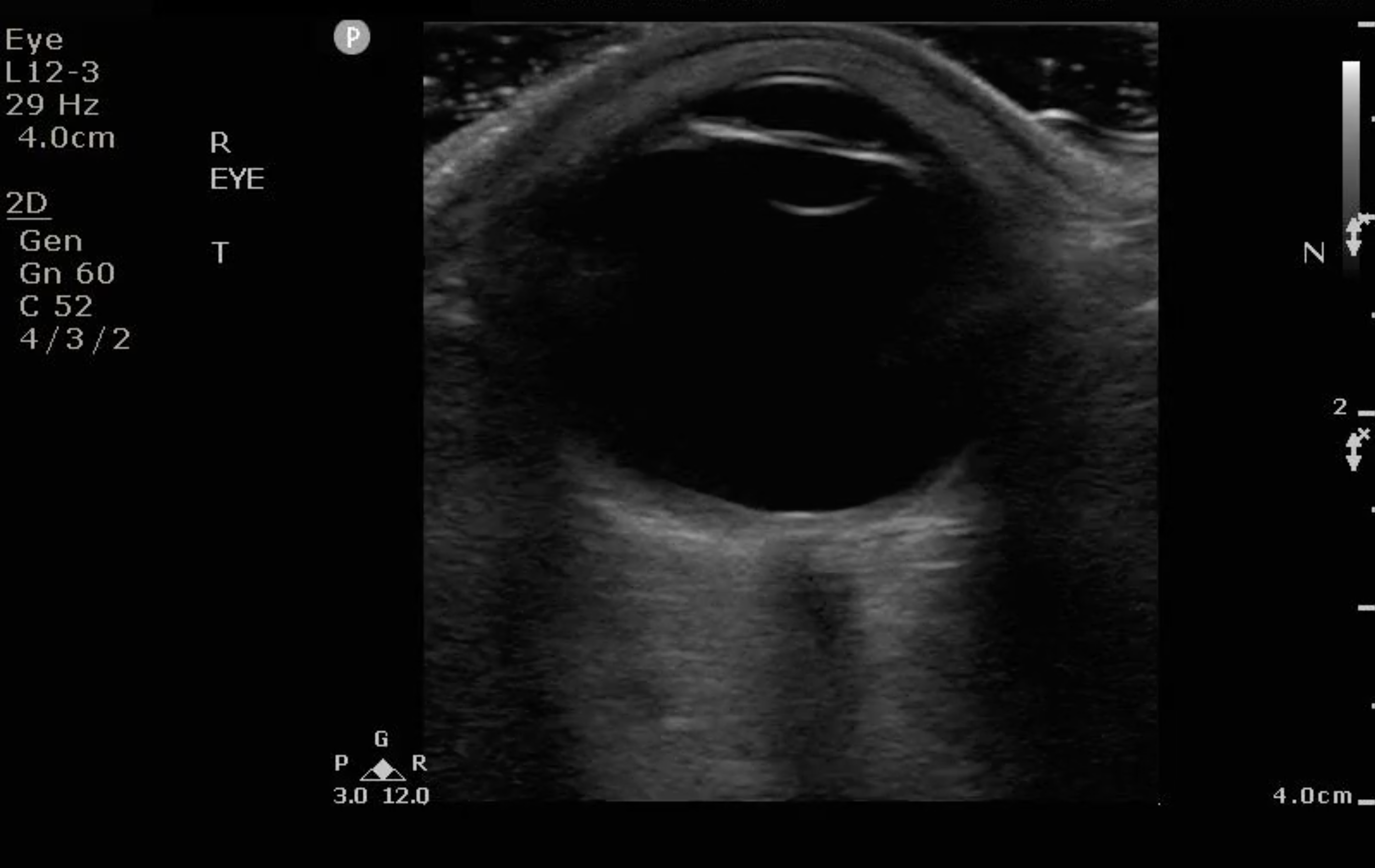 Figure 3- Ultrasound image of a normal eye..png