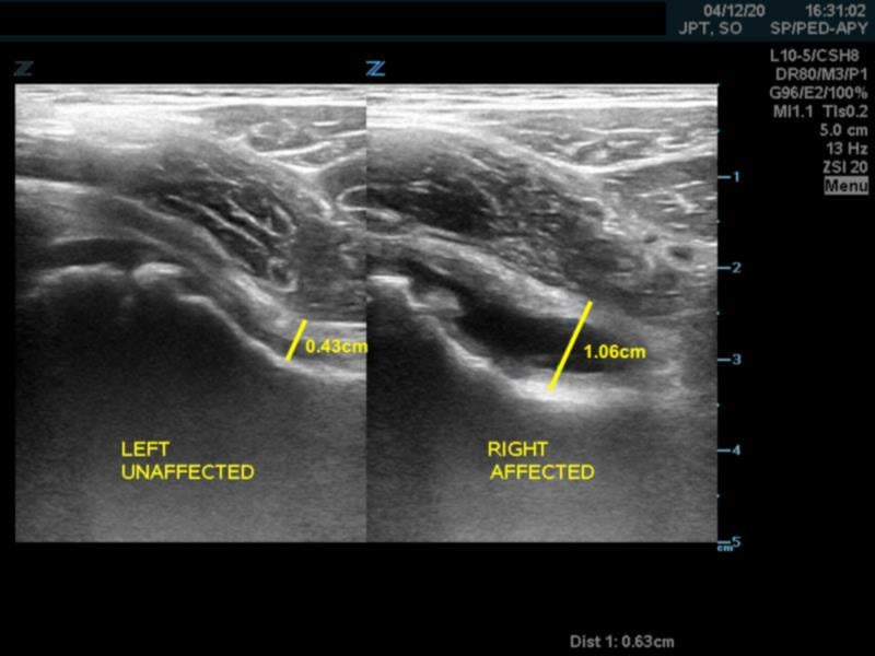 Figure 4. Capsular-synovial thickness.jpg