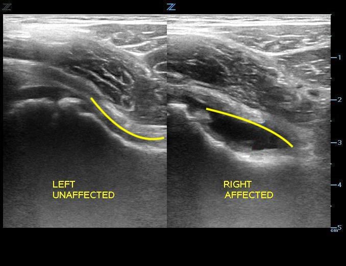 Figure 5. Hip without effusion.jpg