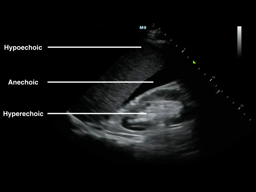 Figure1-B-mode image of free fluid in right upper quadrant.jpeg