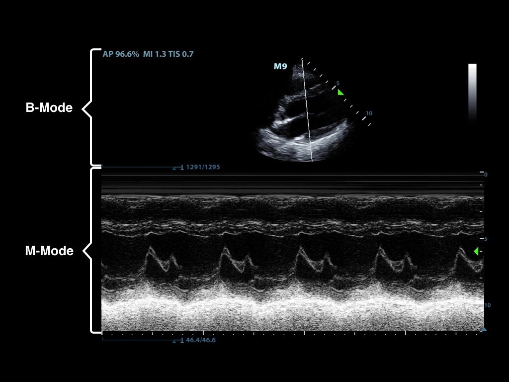 Figure2-M-mode showing movement of the mitral valve.jpeg