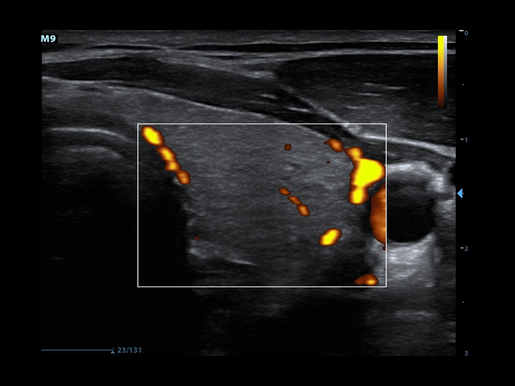 Figure4-Power Doppler showing blood flow in thyroid tissue.jpeg