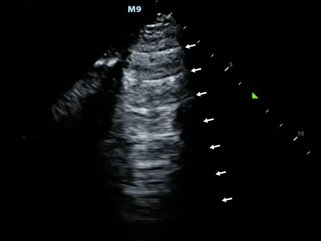 Figure9-Reverberation artifact from the pleural line.jpeg