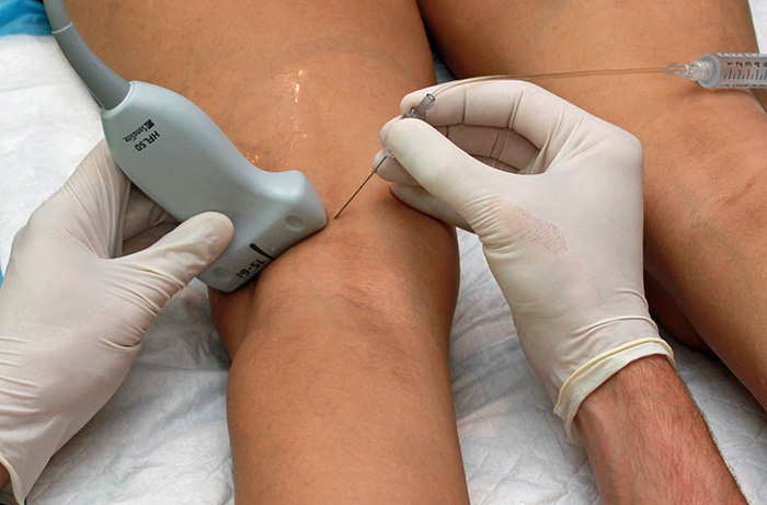 Figure 1. Popliteal nerve block hand positioning.jpg