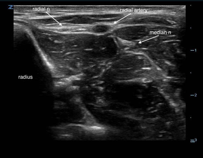 Figure 1. Radial nerve in midforearm.jpg