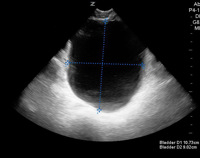 Figure 3- Measurement of bladder in transverse view.jpg