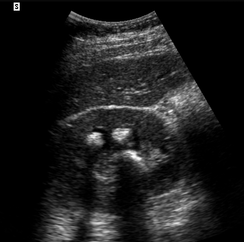 Figure 5- Renal stones (arrows) with shadowing.jpg