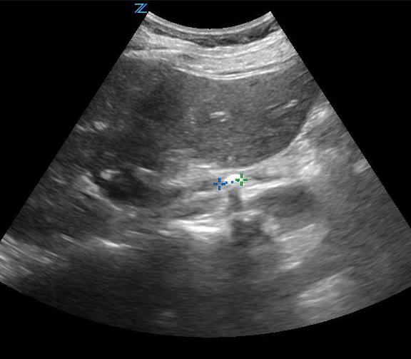 Figure 7- Stone in mid-uterer in setting of hydroureter(Courtesy of Dasia Esener).jpg
