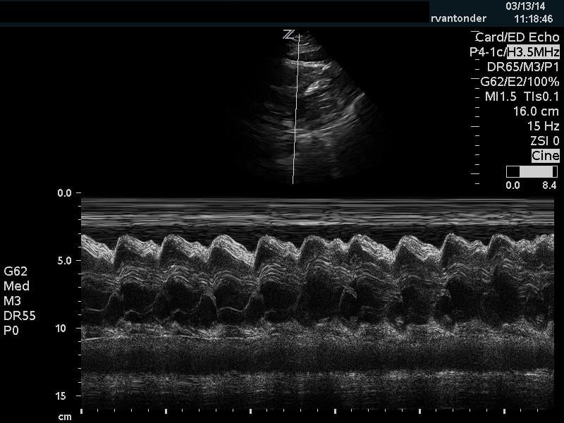 Figure 3 - M-mode tamponade.jpg