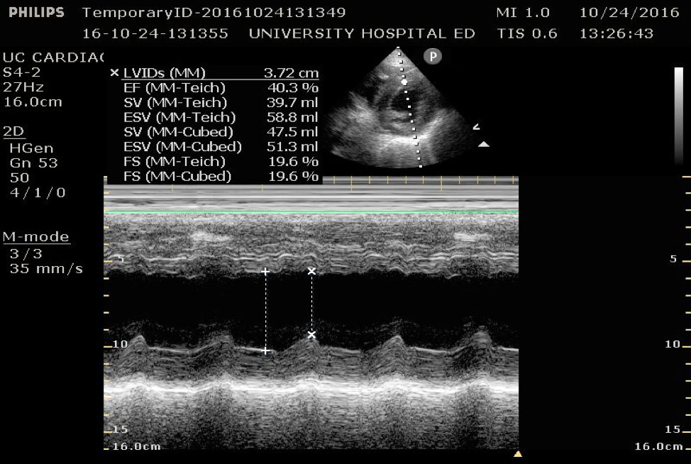 Figure 8 - Parasternal short axis view at the mid-papillary level with fractional shortenin_F3Ek.jpg