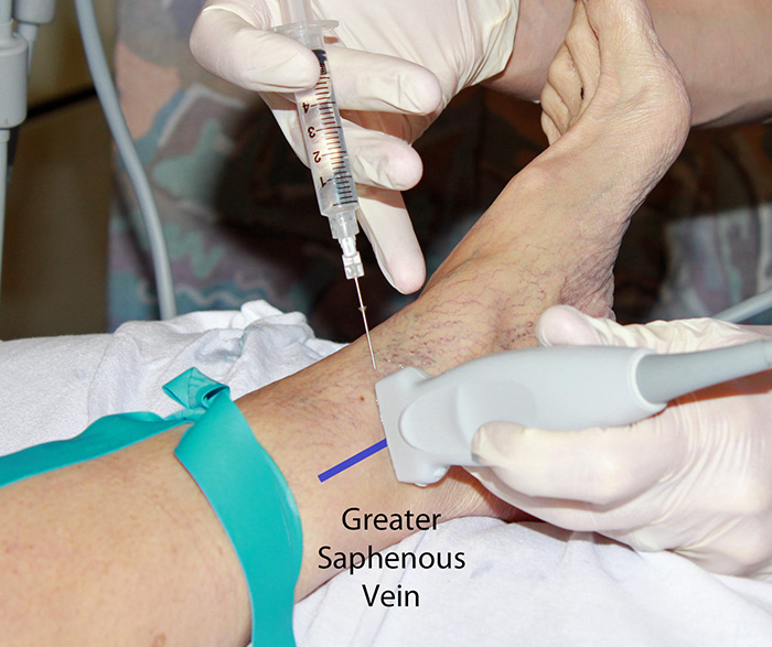 Figure 2. Saphenous nerve block in-plane hands.jpg
